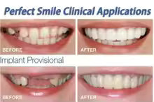 Premium Snap-On Smile – Natural Looking Teeth Instantly
